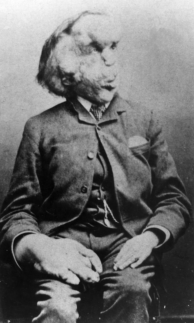 Elephant Man